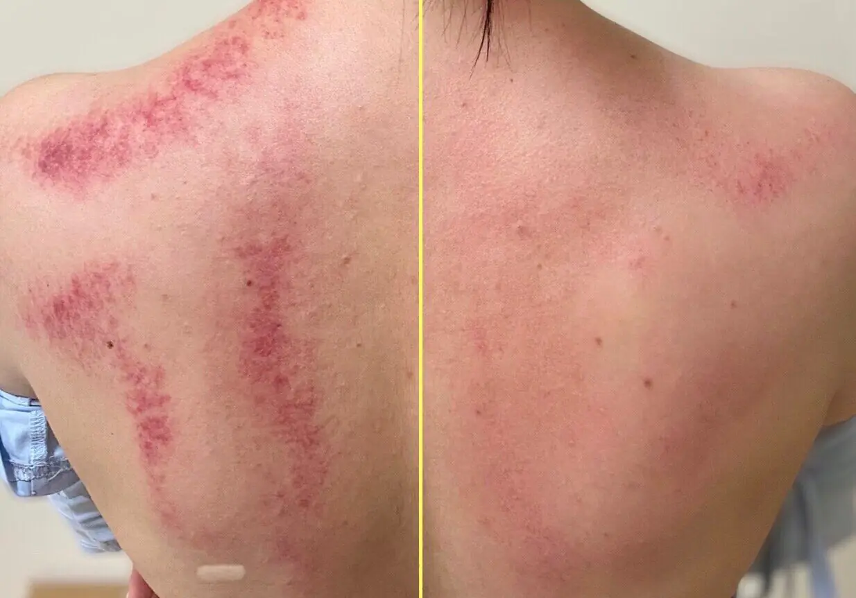 AFK 筋膜刀放鬆整復:釋放筋膜緊繃,重塑身體平衡|高雄整復推薦 2 筋膜刀與刮痧差異 e1725945483126